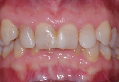 Before - Deep Bite and high canine correction