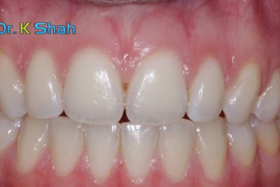 Afterr - Diastema/Space Closure