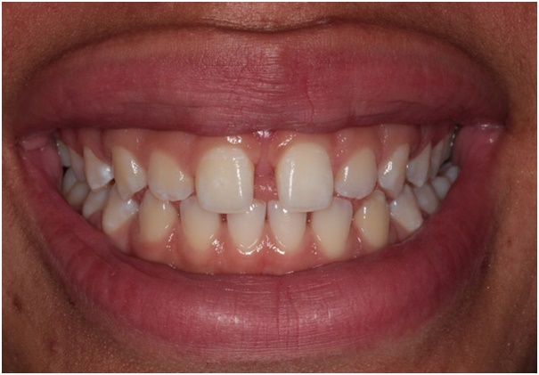 Diastema closure treatment