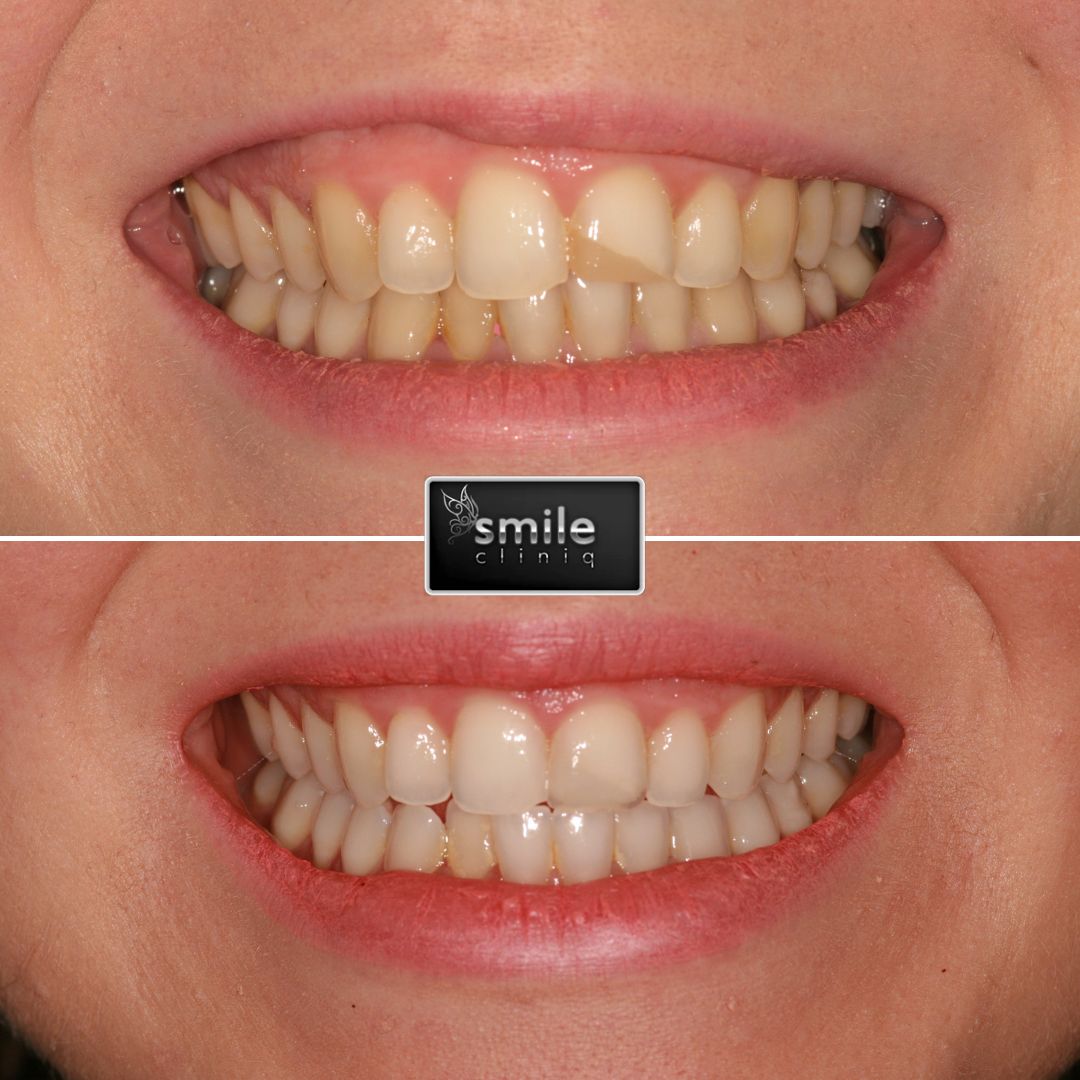 broken tooth filling before and after treated at Emergency Dentist in London Smile Cliniq