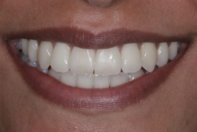 cosmetic_dentist_london_before