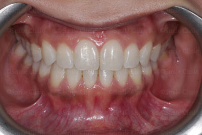 Fastbraces to correct crossbite and a canterd smile after