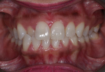 Fastbraces to correct crossbite and a canterd smile before