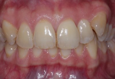 Before - High Canine and crowding correction