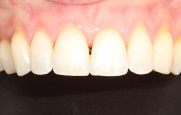 Bioclear_black_triangle_treatment_london_before