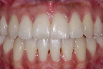 After - Openbite and crossbite correction