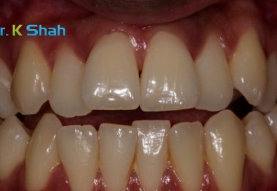 Before - Openbite and crossbite correction