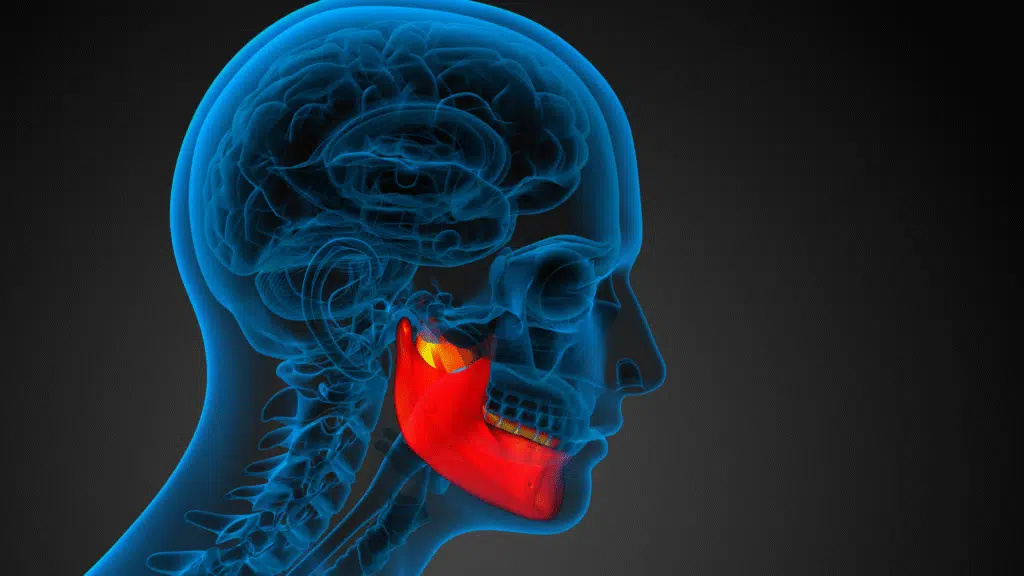 tmj headache