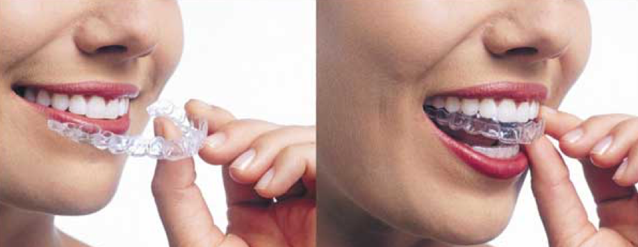 Removable Retention (Essix retainers)