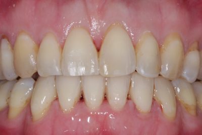After - Rotated teeth aligned