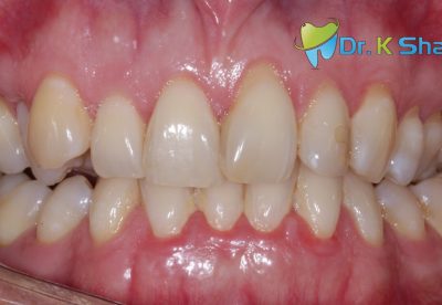 Before - Rotated teeth aligned