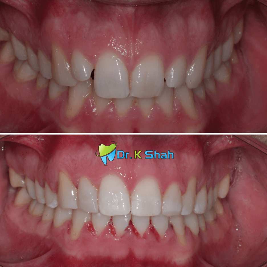 V Shaped arch and peg shaped lateral correction with Fastbraces ® clear and bonding