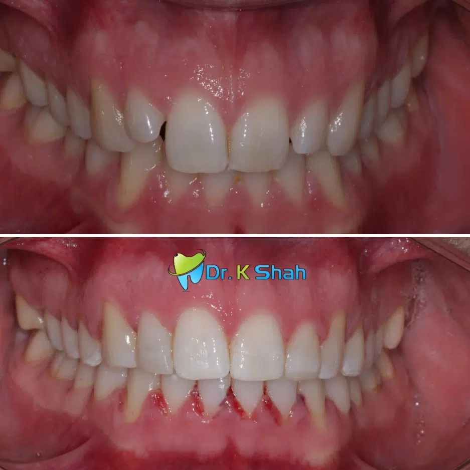V Shaped arch and peg shaped lateral correction with Fastbraces clear and bonding optimised