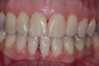 After - Anterior Open bite and crowding
