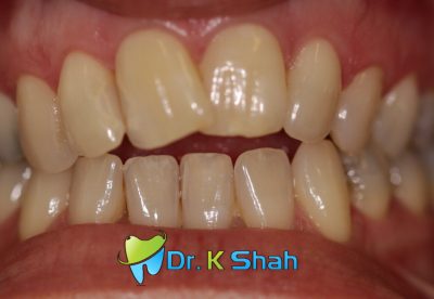 Before - Anterior Open bite and crowding