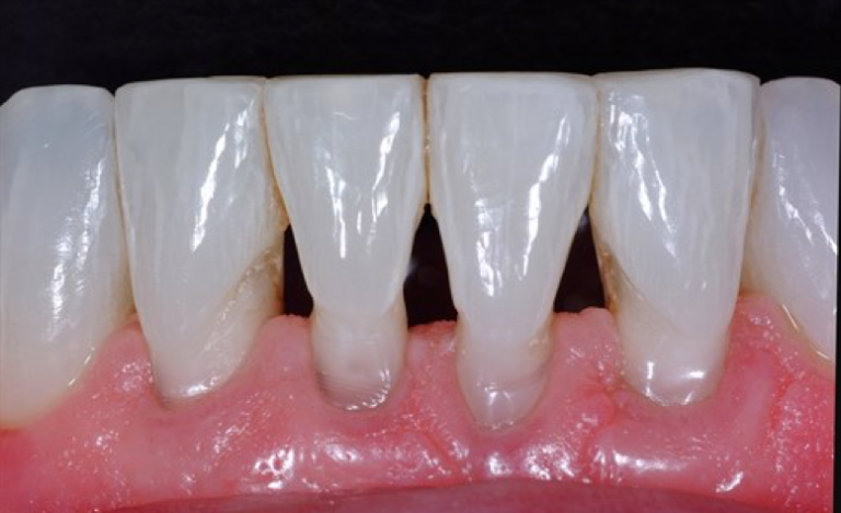 Black Triangle Between Teeth | Gum Recession