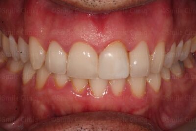 Emergency Dentist London Broken Veneer after