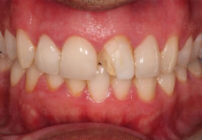 Emergency Dentist Broken London Veneer before