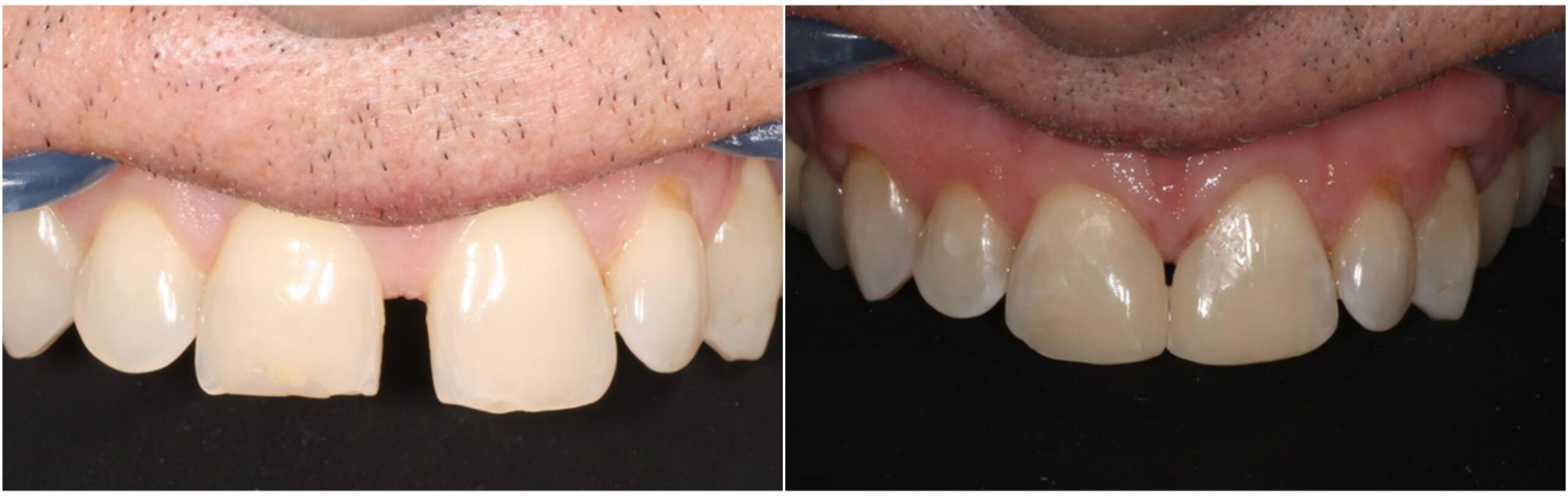 diastema before and after