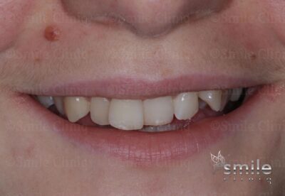 Finchley dentist braces before