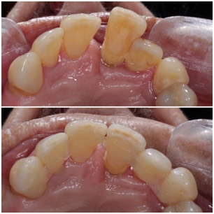 Before periodontal splitting 