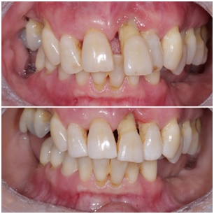 After periodontal splitting