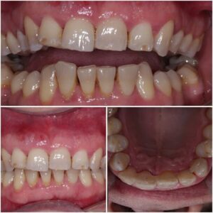 After periodontal splitting teeth picture