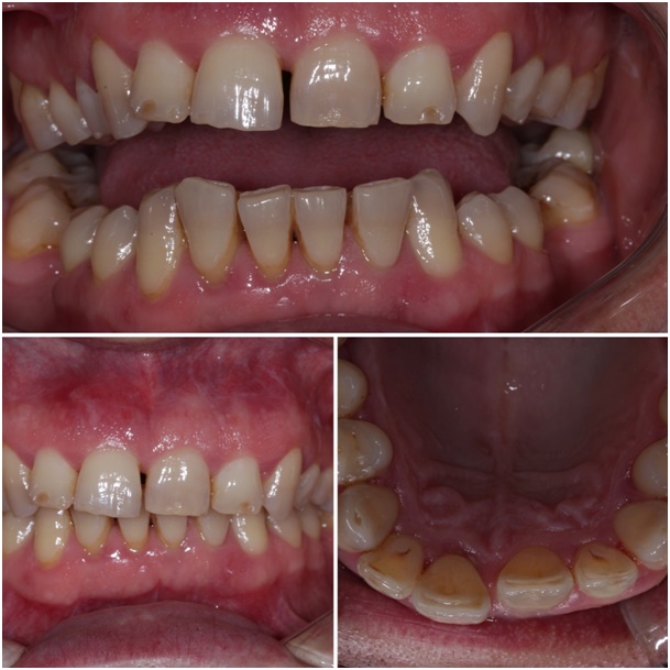 Before periodontal splitting teeth picture