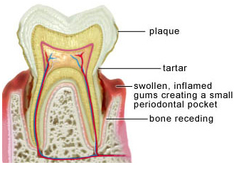 Inflamed tooth diagram