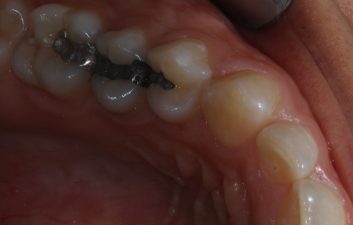 amalgam replacement london dentist