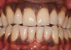 Gingival Depigmentation