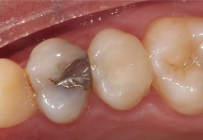 Mercury Filling Removal Before