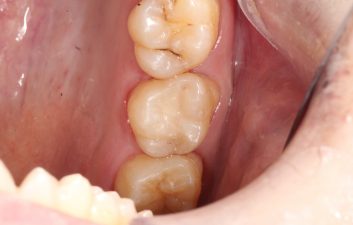 amalgam_filling_removal_london_after