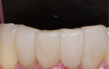 Black triangles london dentist after