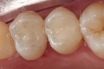 Mercury Filling Removal After