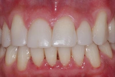 Post bioclear and whitening