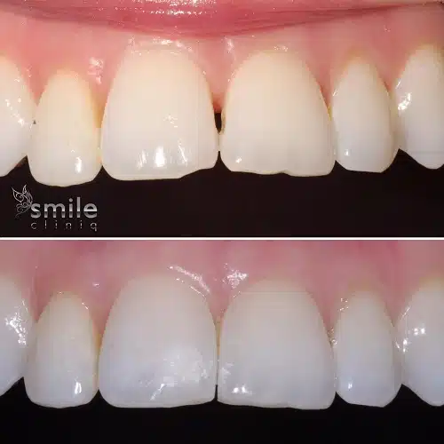 revolutionary bioclear black triangle treatment thumbnail