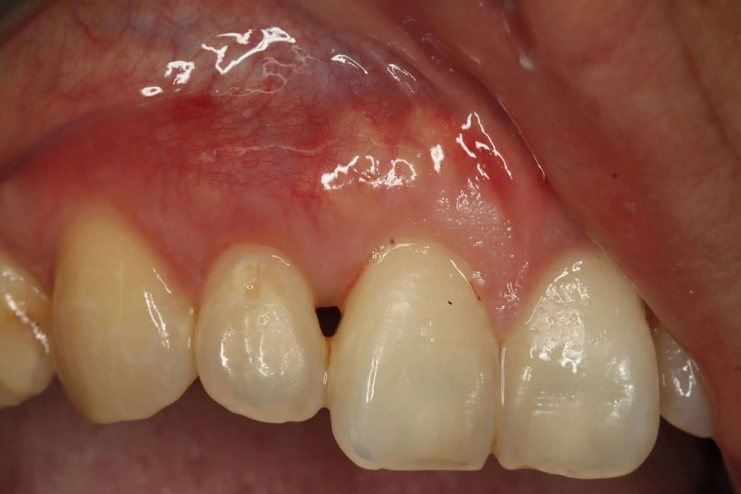 gum recession treatment london after