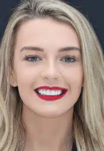 london dental composite bonding full face after sd