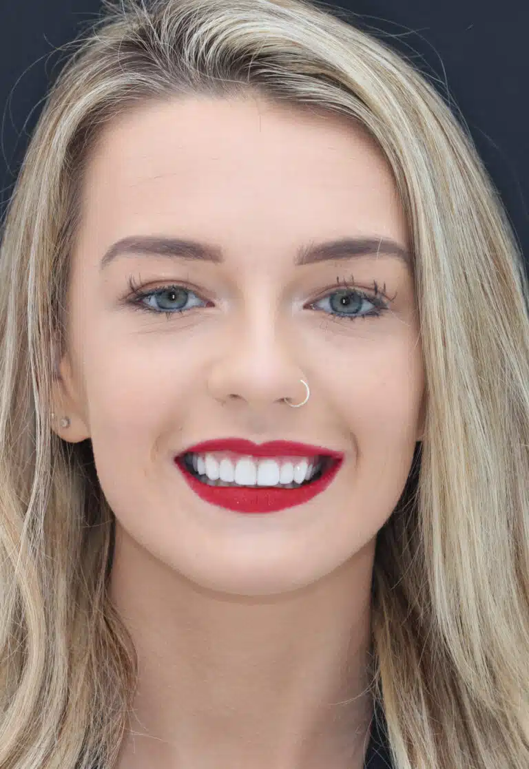 London dental composite bonding Full Face After SD