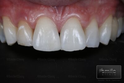 composite bonding and whitening after