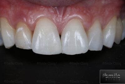 composite bonding and whitening after
