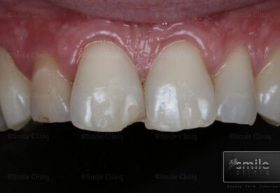composite bonding and whitening before