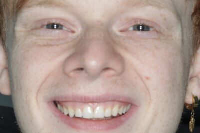 london dentist composite bonding after