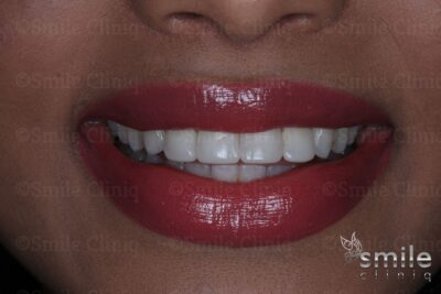 after whitening and bonding st johns wood dentist