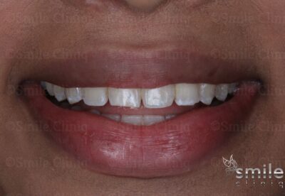 before bonding and whitening st johns wood dentist