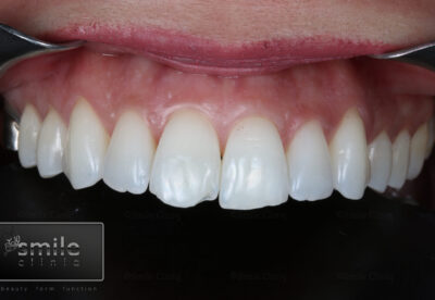 before london dentist composite bonding 