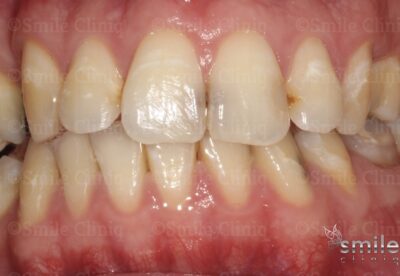 composite bonding front teeth london before