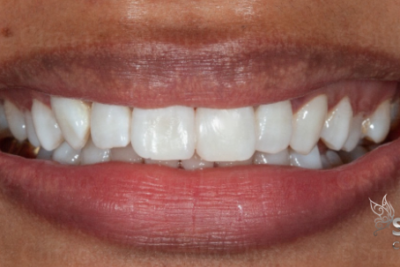 front tooth gap closure bonding after