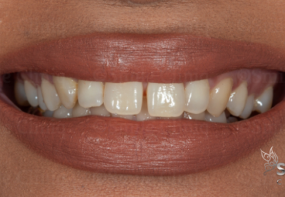 front tooth gap closure bonding before